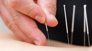 Rückenschmerzen - Akupunktur und Akupressur