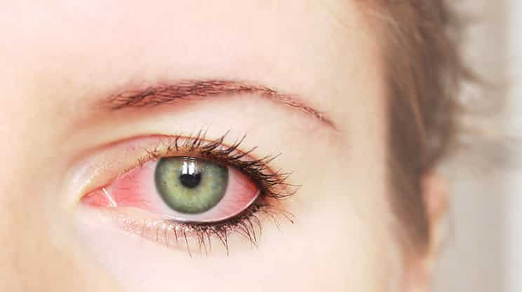 Augengrippe auf dem Vormarsch – was tun?