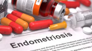 Endometriose - harmlos und doch gefährlich