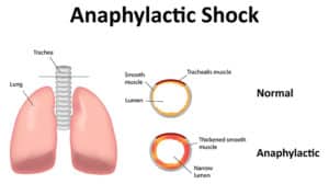 Der anaphylaktische Schock - die schwerste Form der Allergie
