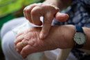 Arthritis: Was tun gegen die Gelenkschmerzen?