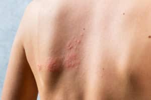 Nesselsucht - eine häufig auftretende Hautkrankheit