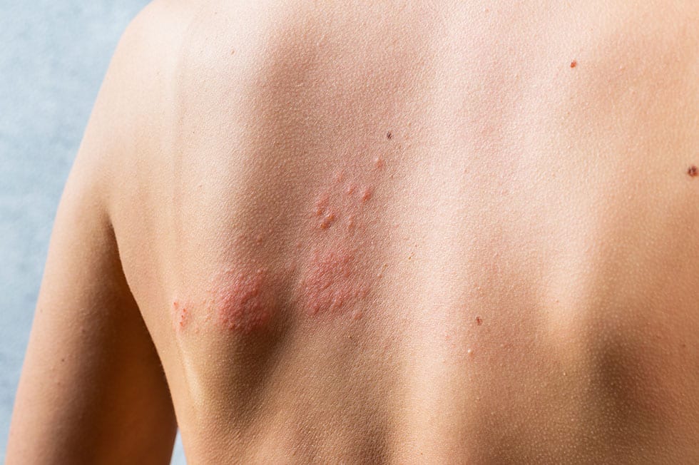 Nesselsucht – eine häufig auftretende Hautkrankheit