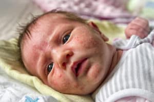Wenn Neugeborene unter Akne leiden