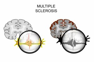 Multiple Sklerose – eine Krankheit, die jeden treffen kann