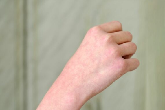Toasted-Skin-Syndrom – wenn die Haut leidet