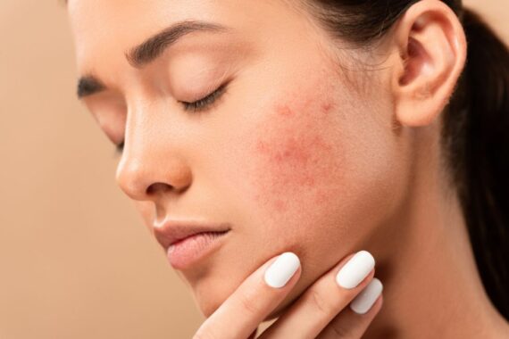 Akne und Hautunreinheiten